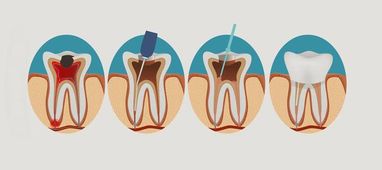 5 найпопулярніших міфів про зараження зубних каналів