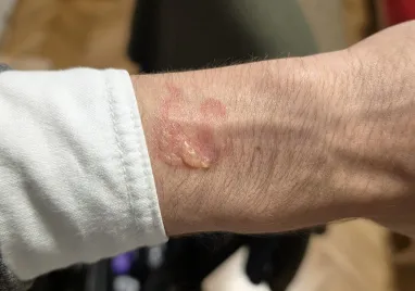 Власники Samsung Galaxy Watch скаржаться на опіки — чому так (фото)
